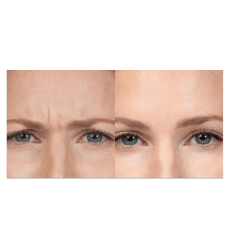 before and after Botox Glabella Glow Medispa