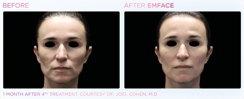 Ultra Lift Non Surgical Face Lift, Medical Spa