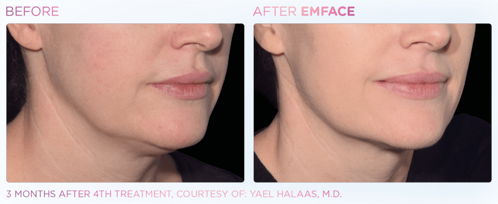 before and after emface three month result