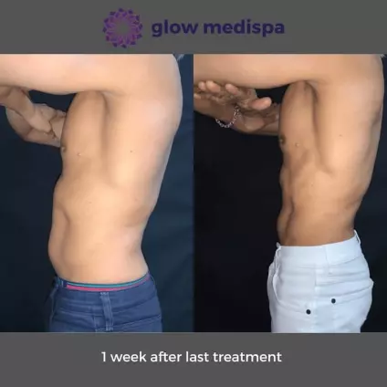 Are body sculpting results permanent? - Glow Medispa