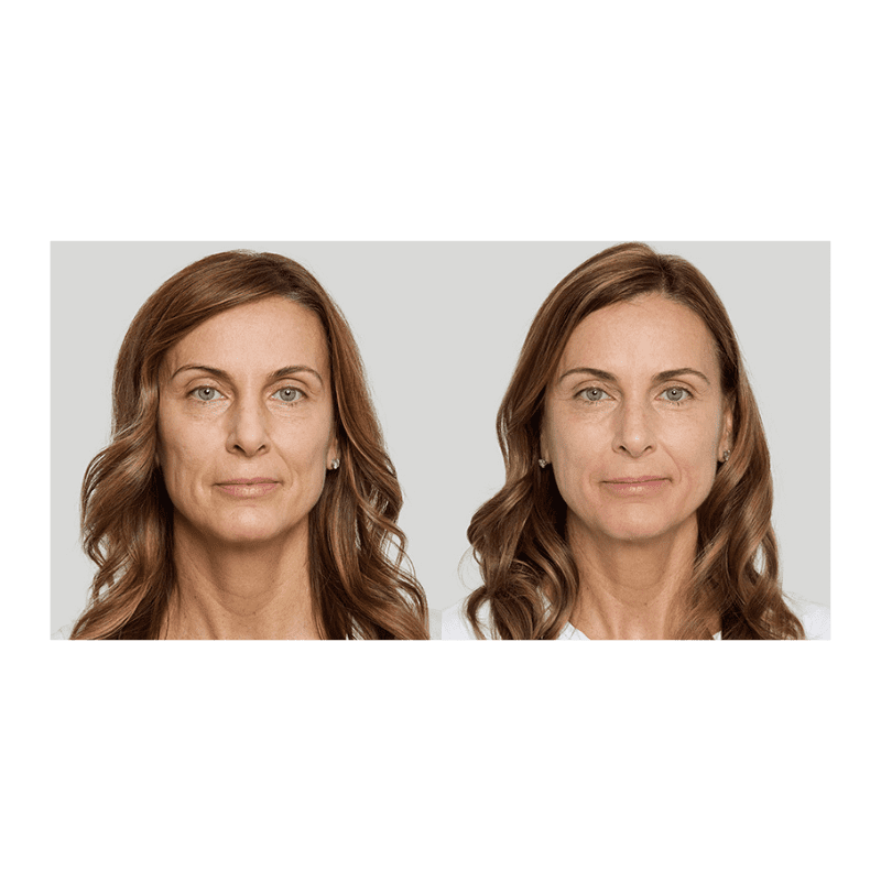 Sculptra