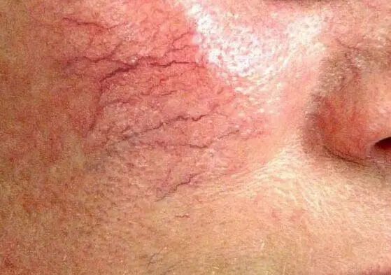 spider veins on face