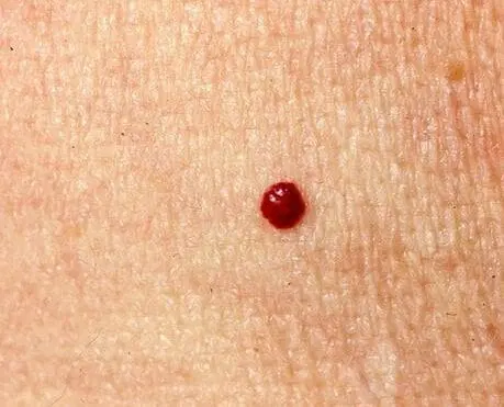 cherry hemangiomas