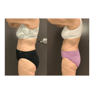 emsculpt neo Abdomen Kirkland