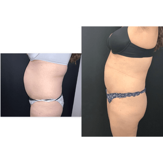 emsculpt neo Abdomen Seattle