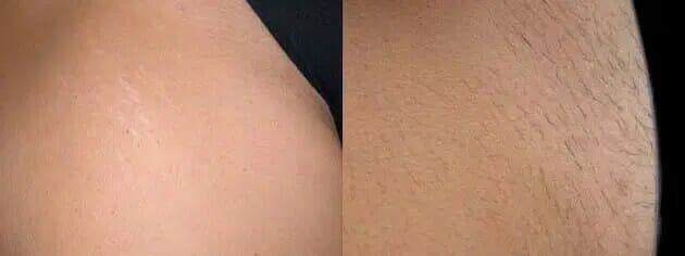 Brazillian Laser Hair Removal Glow Medispa