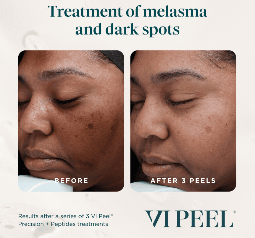 vi peel